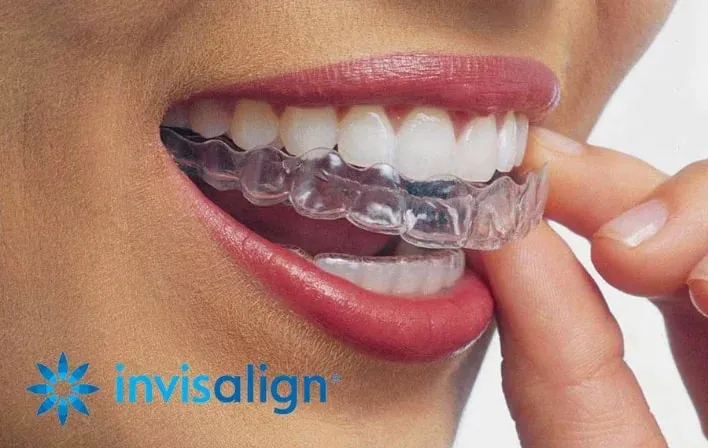 Clear Invisalign aligner fitted on the teeth — orthodontic treatment Luxembourg