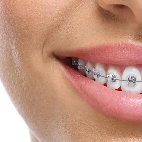 Metal orthodontic braces on teeth — orthodontics Luxembourg
