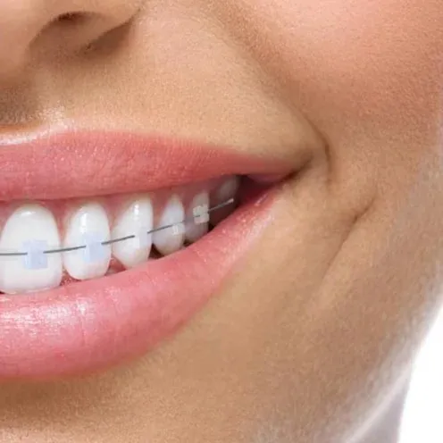 Tooth-coloured ceramic orthodontic braces — orthodontics Luxembourg
