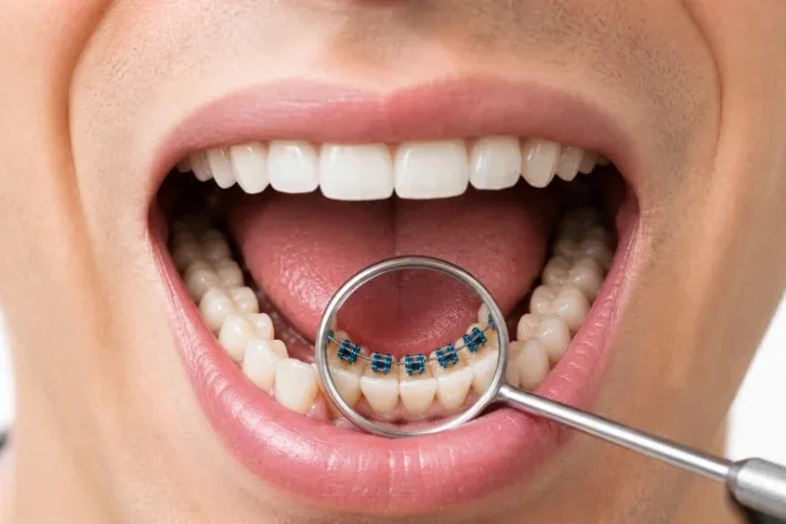 Lingual braces fitted behind the teeth — invisible orthodontics Luxembourg